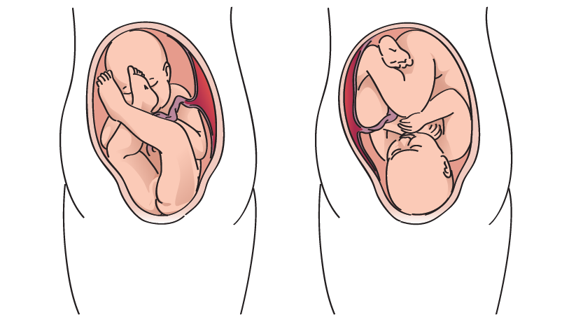 illustration of breech and normal position