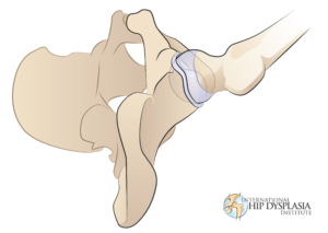 illustration of normal hip